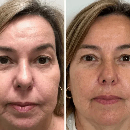 Collagen Fit™ - Maska za pomlađivanje kolagena