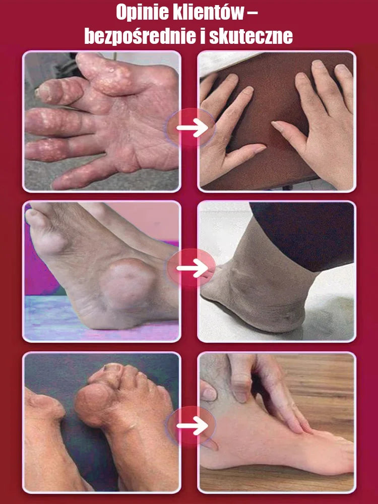 Medicinski gel za zglobove za giht. Ne trpite napade gihta! Ovaj gel se brzo upija, djeluje za 10 minuta i ublažava oteklinu i bol!